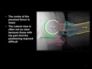 • The cortex of the
proximal femur is
intact
• The Lateral view is
often not so clear
because those with
hip pain find the
positioning required
difficult
7
 