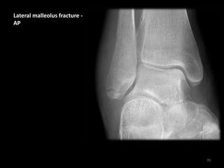 Lateral malleolus fracture -
AP
70
 