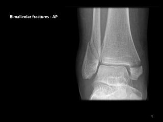 Bimalleolar fractures - AP
72
 