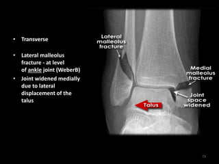 • Transverse medial
malleolus fracture
• Lateral malleolus
fracture - at level
of ankle joint (WeberB)
• Joint widened medially
due to lateral
displacement of the
talus
73
 