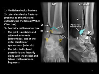 1 - Medial malleolus fracture
2 - Lateral malleolus fracture -
proximal to the ankle and
extending up the fibula (Weber
C fracture)
3 - Posterior malleolus fracture
• The joint is unstable and
widened anteriorly
(arrowheads) and at the
distal tibiofibular
syndesmosis (asterisk)
• The talus is displaced
posteriorly and laterally
along with the medial and
lateral malleolus bone
fragments
75
 
