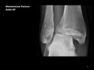 Maisonneuve fracture -
Ankle AP
76
 