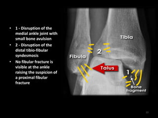 • 1 - Disruption of the
medial ankle joint with
small bone avulsion
• 2 - Disruption of the
distal tibio-fibular
syndesmosis
• No fibular fracture is
visible at the ankle
raising the suspicion of
a proximal fibular
fracture
77
 
