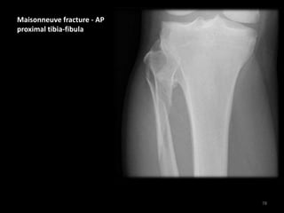 Maisonneuve fracture - AP
proximal tibia-fibula
78
 