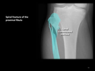 Spiral fracture of the
proximal fibula
79
 