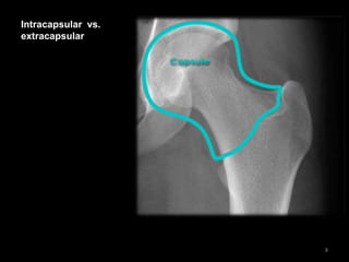 Intracapsular vs.
extracapsular
8
 