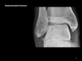 Osteochondral fracture
80
 