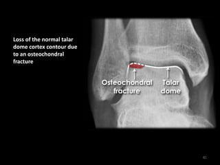 Loss of the normal talar
dome cortex contour due
to an osteochondral
fracture
81
 