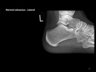 Normal calcaneus - Lateral
82
 