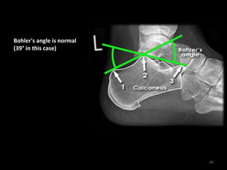 Bohler's angle is normal
(39° in this case)
83
 