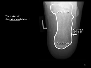 The cortex of
the calcaneus is intact
85
 