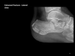 Calcaneal fracture - Lateral
view
86
 
