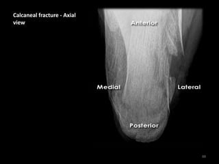 Calcaneal fracture - Axial
view
88
 