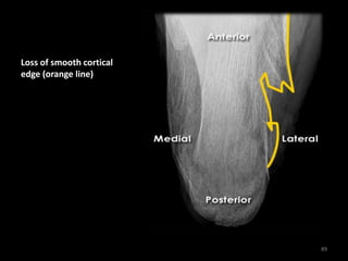 Loss of smooth cortical
edge (orange line)
89
 