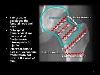 • The capsule
envelopes the
femoral head and
neck
• Subcapital,
transcervical and
basicervical
fractures are
intracapsular hip
injuries
• Intertrochanteric
and subtrochanteric
fractures do not
involve the neck of
femur
9
 