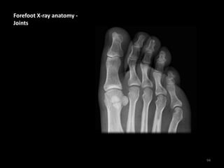 Forefoot X-ray anatomy -
Joints
94
 