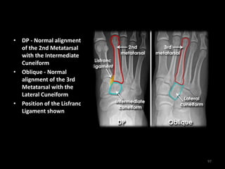 • DP - Normal alignment
of the 2nd Metatarsal
with the Intermediate
Cuneiform
• Oblique - Normal
alignment of the 3rd
Metatarsal with the
Lateral Cuneiform
• Position of the Lisfranc
Ligament shown
97
 