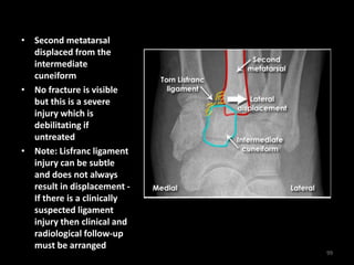 • Second metatarsal
displaced from the
intermediate
cuneiform
• No fracture is visible
but this is a severe
injury which is
debilitating if
untreated
• Note: Lisfranc ligament
injury can be subtle
and does not always
result in displacement -
If there is a clinically
suspected ligament
injury then clinical and
radiological follow-up
must be arranged
99
 