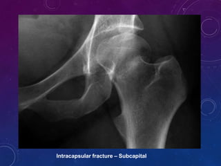 Intertrochanteric fracture
 