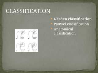 LOWER LIMB FRACTURES in adults, mva.pptx
