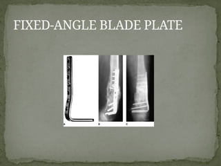 LOWER LIMB FRACTURES in adults, mva.pptx
