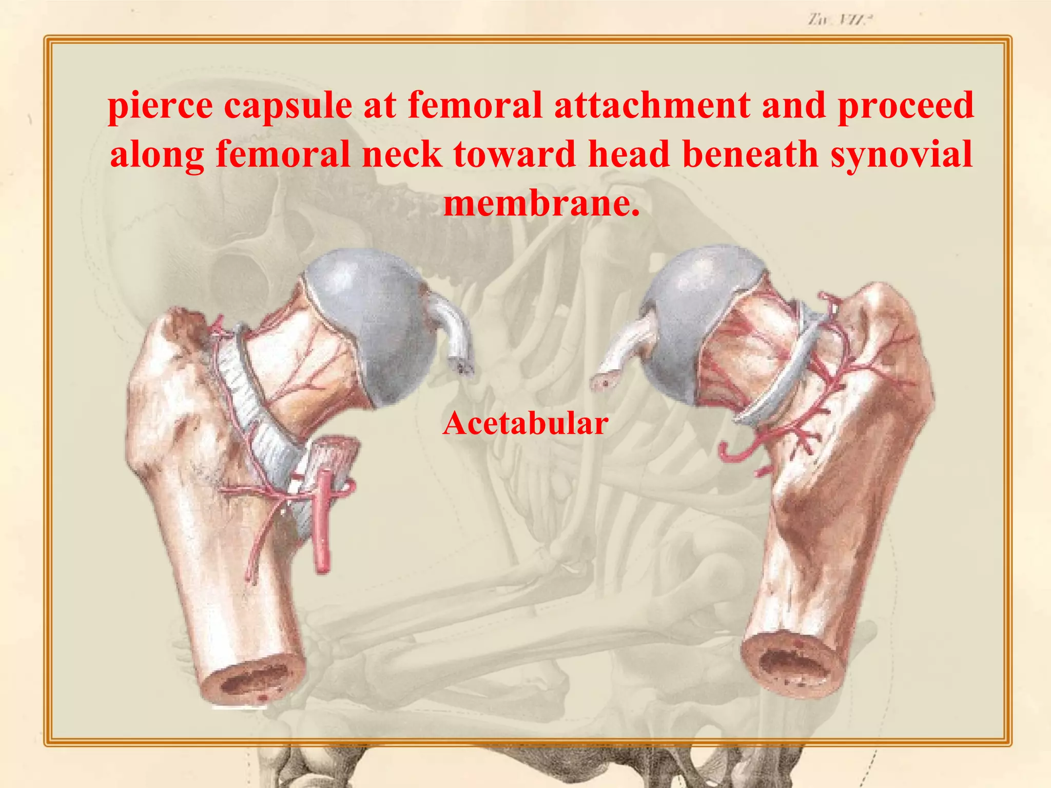 pierce capsule at femoral attachment and proceed
along femoral neck toward head beneath synovial
membrane.

Acetabular

 