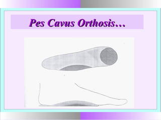 Pes Cavus Orthosis…Pes Cavus Orthosis…
 