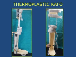 THERMOPLASTIC KAFO
 