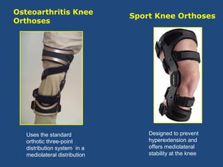 Osteoarthritis Knee
Orthoses
Sport Knee Orthoses
Uses the standard
orthotic three-point
distribution system in a
mediolateral distribution
Designed to prevent
hyperextension and
offers mediolateral
stability at the knee
 