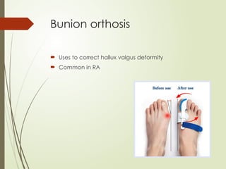 Bunion orthosis
 Uses to correct hallux valgus deformity
 Common in RA
 