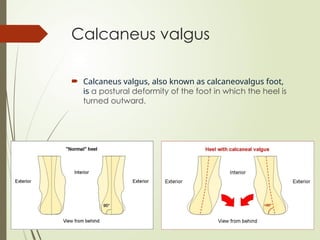 Calcaneus valgus
 Calcaneus valgus, also known as calcaneovalgus foot,
is a postural deformity of the foot in which the heel is
turned outward.
 