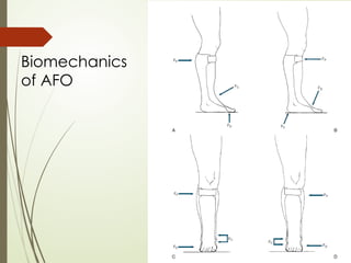 Biomechanics
of AFO
 