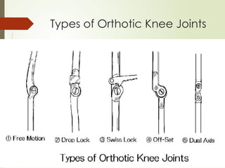 Types of Orthotic Knee Joints
 