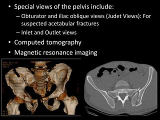 Lower limb fractures part 1 (for UGs) | PPTX