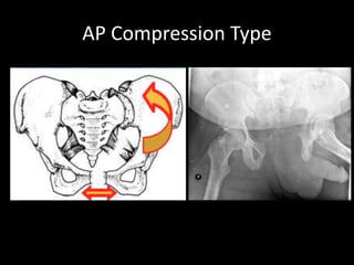 Lower limb fractures part 1 (for UGs) | PPTX