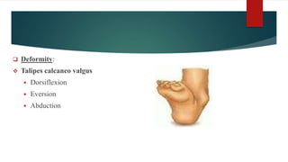  Deformity:
 Talipes calcaneo valgus
 Dorsiflexion
 Eversion
 Abduction
 