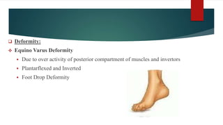 Deformity:
 Equino Varus Deformity
 Due to over activity of posterior compartment of muscles and invertors
 Plantarflexed and Inverted
 Foot Drop Deformity
 