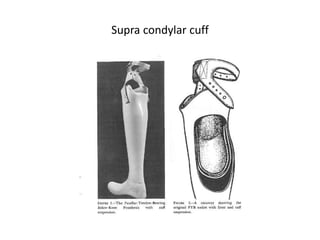 Supra condylar cuff
 