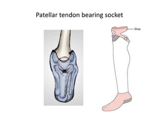 Patellar tendon bearing socket
 