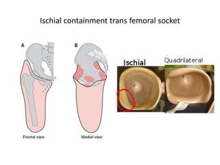 Ischial containment trans femoral socket
 