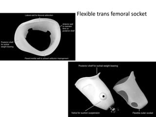 Flexible trans femoral socket
 