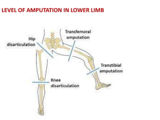 LEVEL OF AMPUTATION IN LOWER LIMB
 