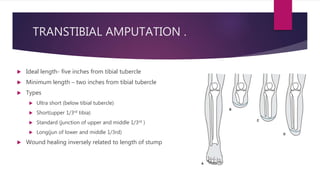 TRANSTIBIAL AMPUTATION .
 Ideal length- five inches from tibial tubercle
 Minimum length – two inches from tibial tubercle
 Types
 Ultra short (below tibial tubercle)
 Short(upper 1/3rd tibia)
 Standard (junction of upper and middle 1/3rd )
 Long(jun of lower and middle 1/3rd)
 Wound healing inversely related to length of stump
 