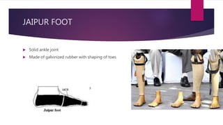 JAIPUR FOOT
 Solid ankle joint
 Made of galvinized rubber with shaping of toes
 
