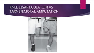 KNEE DISARTICULATION VS
TARNSFEMORAL AMPUTATION
 