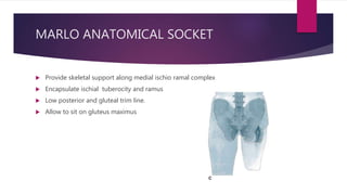 MARLO ANATOMICAL SOCKET
 Provide skeletal support along medial ischio ramal complex
 Encapsulate ischial tuberocity and ramus
 Low posterior and gluteal trim line.
 Allow to sit on gluteus maximus
 