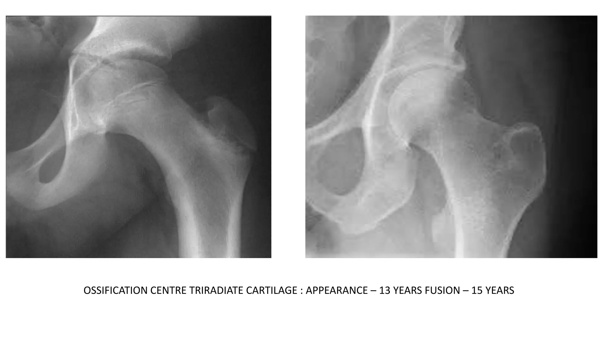 Tri Radiate Array Lower limb radiology | PPTX