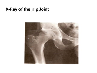 X-Ray of the Hip Joint
 
