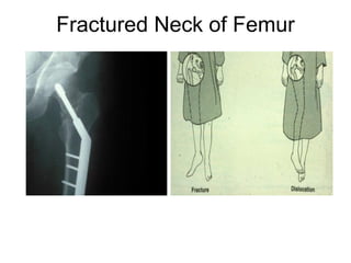 Fractured Neck of Femur
 