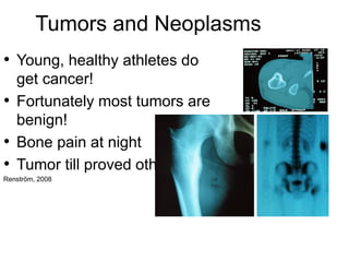 Tumors and Neoplasms
• Young, healthy athletes do
get cancer!
• Fortunately most tumors are
benign!
• Bone pain at night
• Tumor till proved otherwise
Renström, 2008
 